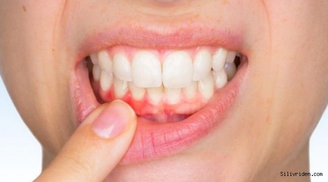 Diş eti kanaması neden olur kan damarlarının artması neden oluyor