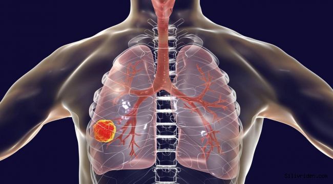 Akciğer kanserinde ölüm oranları giderek azalıyor