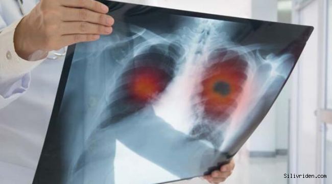 “COVID-19 için çekilen tomografiler akciğer kanserlerini erken evrede yakaladı”
